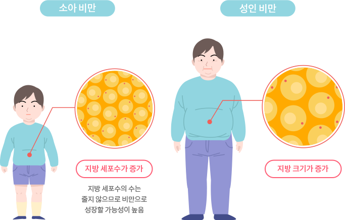 소아 비만은 성인 비만과 달리 지방 세포수가 증가