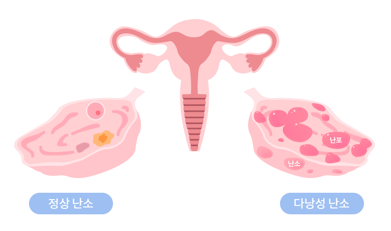 다낭성 난소 증후군